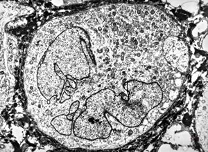 M,58y. | carcinoma gl. parotis